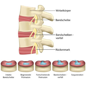 Bandscheibenvorfall - Wirbelsule