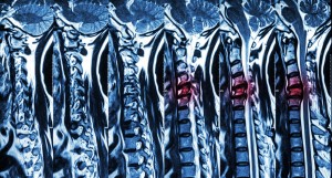 Cervical spondylosis with disc herniation ( MRI of cervical spine : show cervical spondylosis with disc herniation compress spinal cord ( Myelopathy ) )